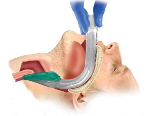 Ларингеальная маска. Алгоритм постановки.